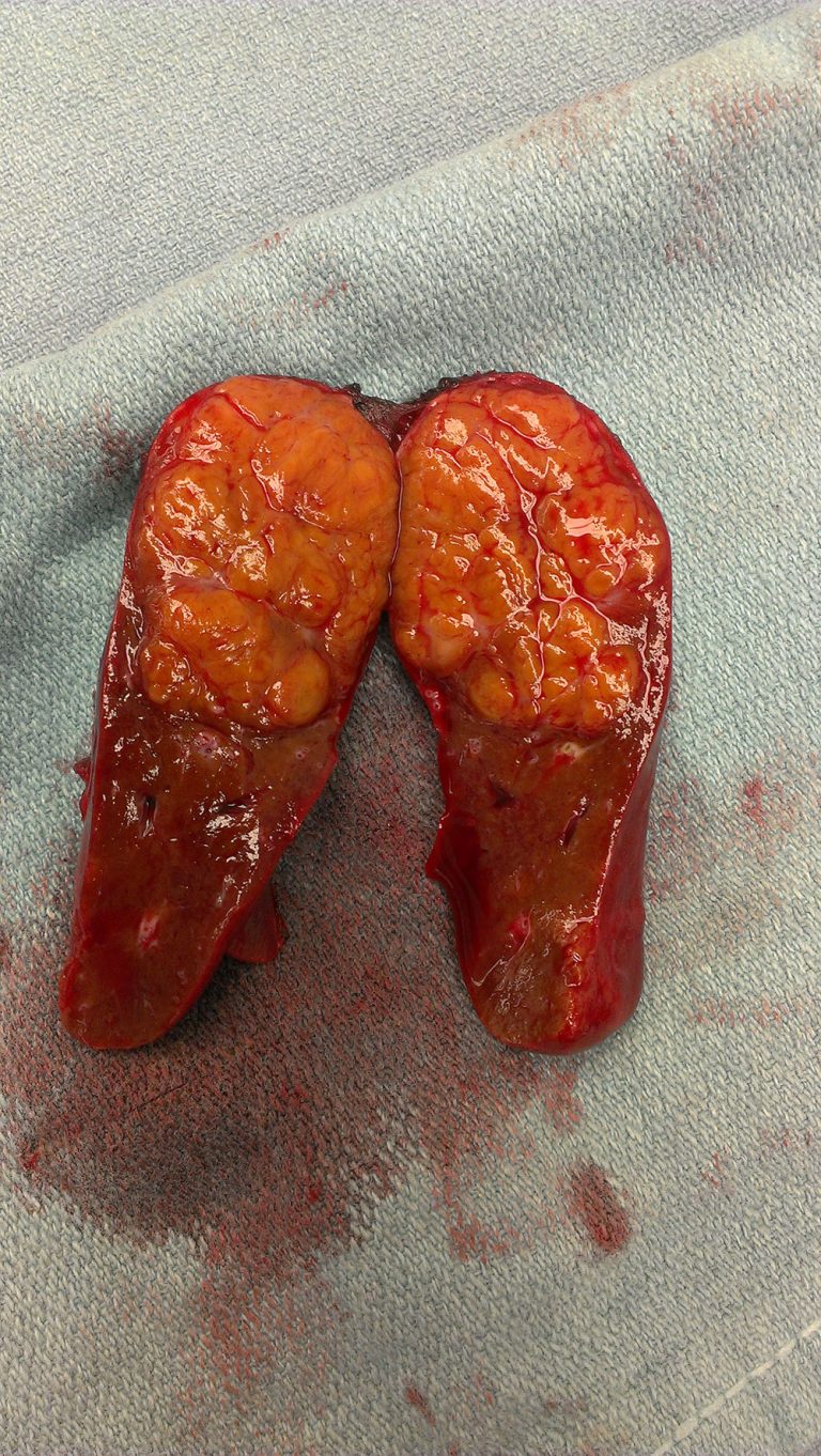 Liver Cancer surgery FORSYTH SURGICAL